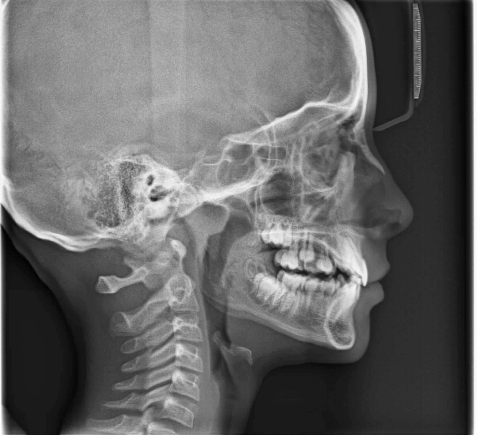 X-Ray Dental