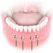 miniśruby ortodontyczne w jamie ustnej